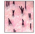 follicular unit hair transplantation