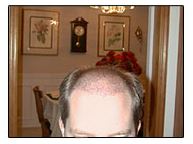 Day 8 post hair transplant