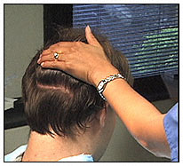 Female Pattern Baldness