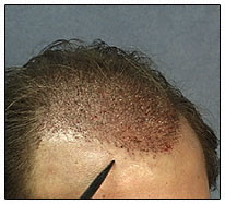 Female Pattern Baldness