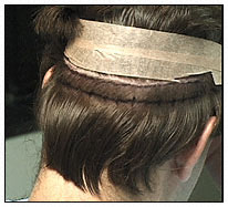 Female Pattern Baldness