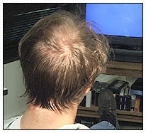 Female Pattern Baldness