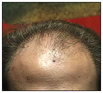 Female Pattern Baldness