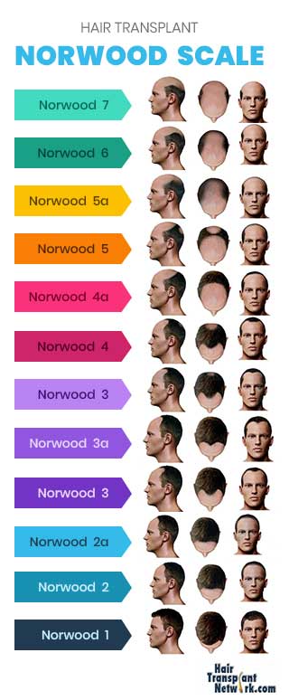 Norwood Scale