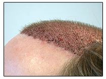 After hair transplant surgery