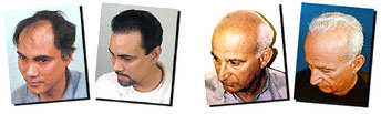 hair transplant photos