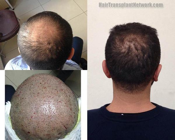 Hair restoration procedure before and after pictures