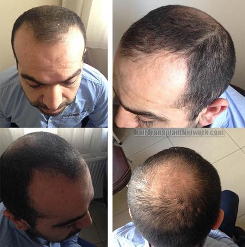 Hair restoration procedure before pictures