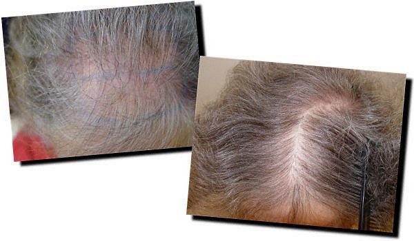 Hair restoration procedure results