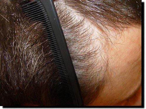 Hair restoration procedure results