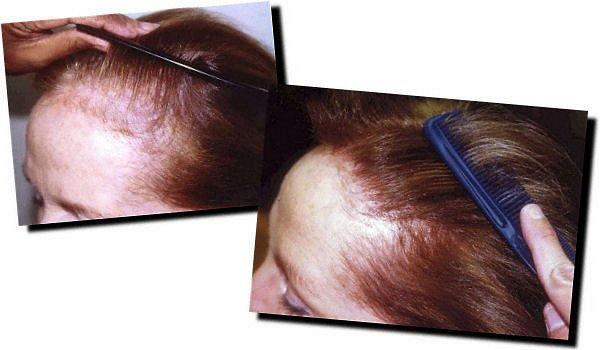 Hair restoration procedure results