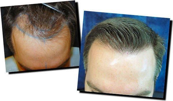 Hair restoration procedure results