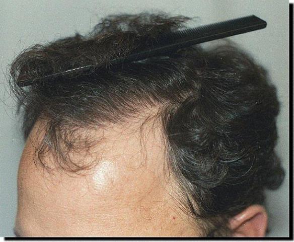 Hair restoration procedure results