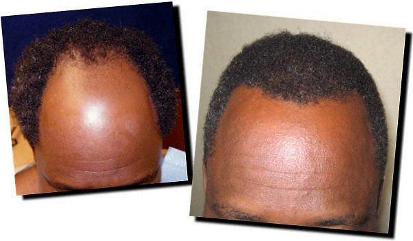 Hair restoration procedure results