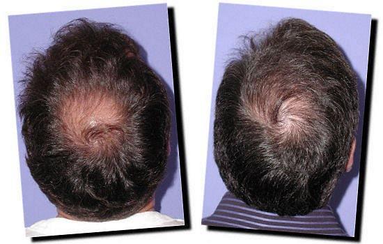 Hair restoration procedure results