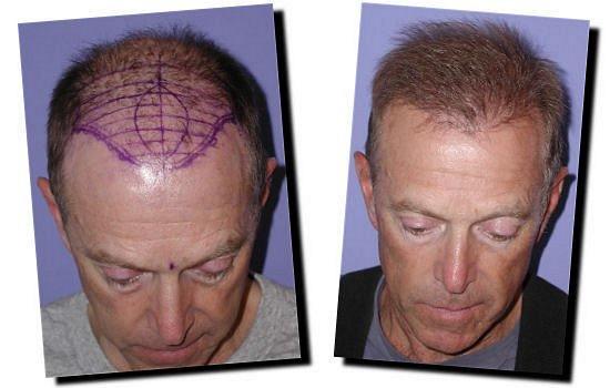 Hair restoration procedure results