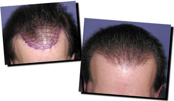 Hair restoration procedure results