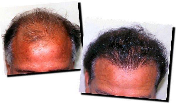 Hair restoration procedure results