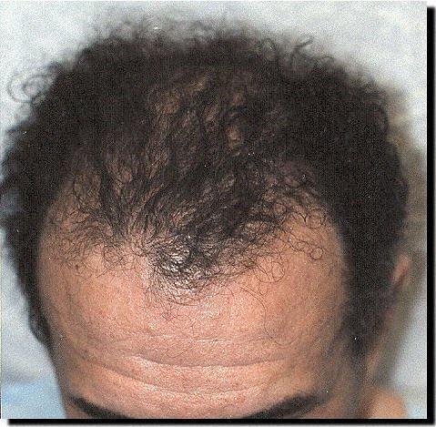 Hair restoration procedure results