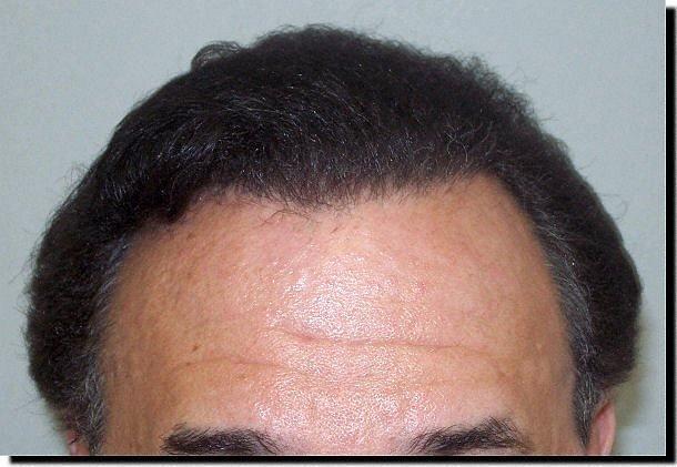 Hair restoration procedure results