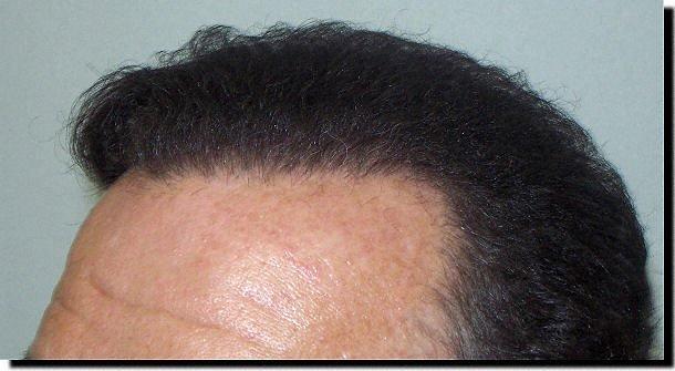 Hair restoration procedure results