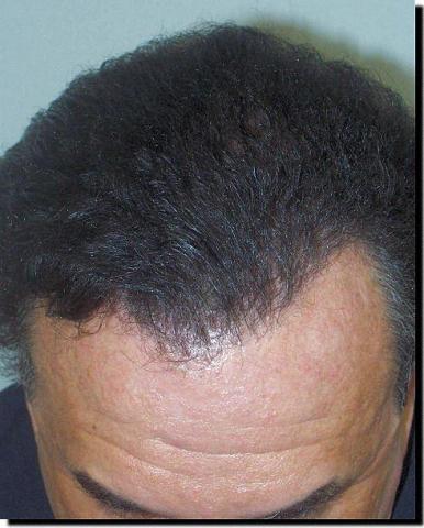 Hair restoration procedure results