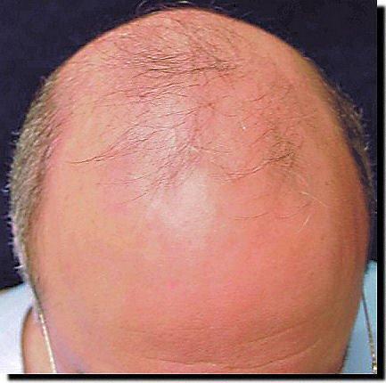 Hair restoration procedure results