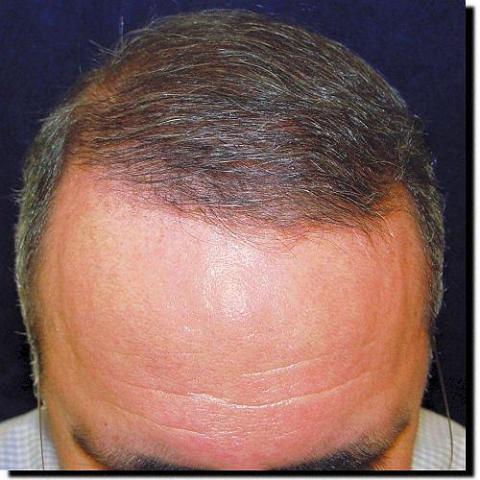 Hair restoration procedure results