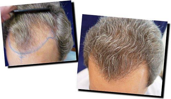 Hair restoration procedure results