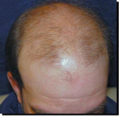 Hair restoration procedure results