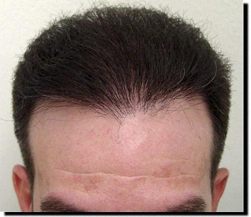 Hair restoration procedure results