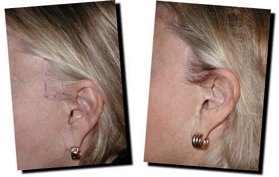 Hair restoration procedure results