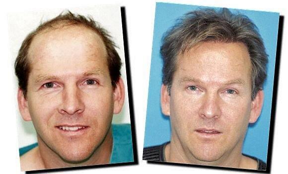 Hair restoration procedure results