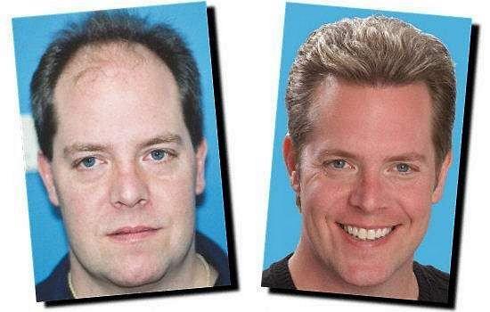 Hair restoration procedure results