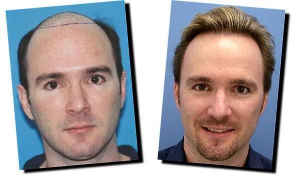 Hair restoration procedure results