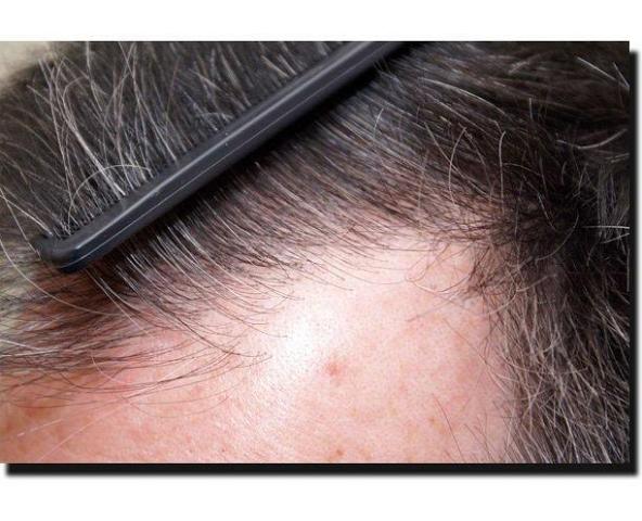 Hair restoration procedure results