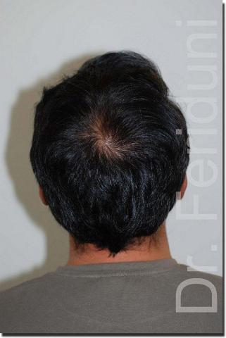 Hair restoration procedure results