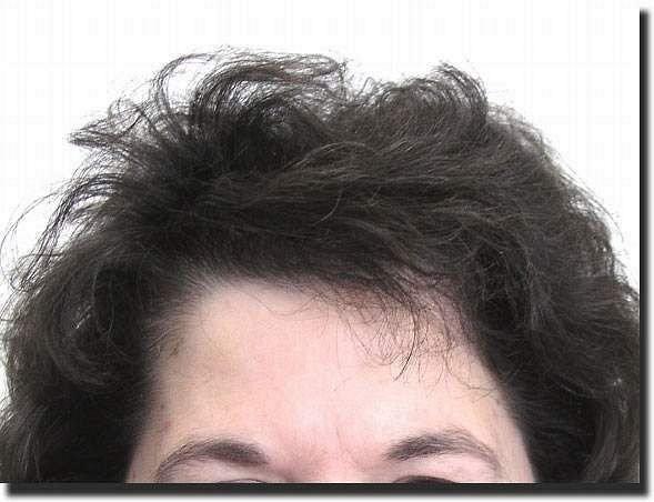 Hair restoration procedure results