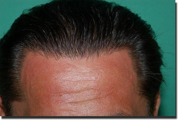 Hair restoration procedure results