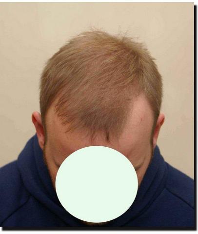 Hair restoration procedure results