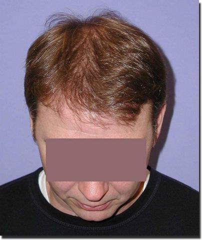 Hair restoration procedure results