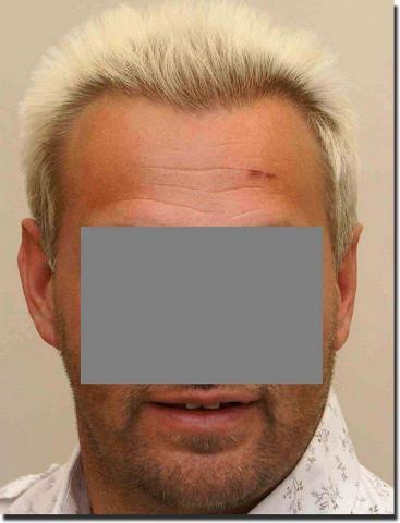 Hair restoration procedure results