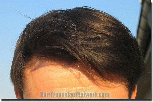 Hair restoration procedure results