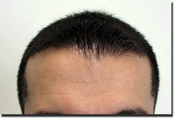 Hair restoration procedure results