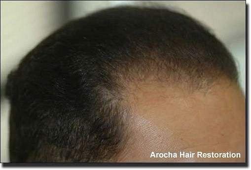 Hair restoration procedure results