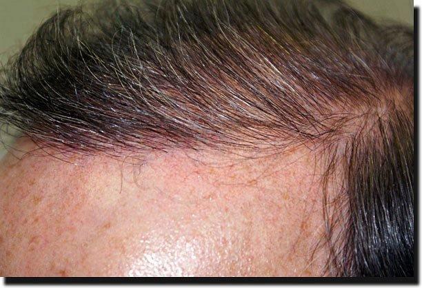 Hair restoration procedure results