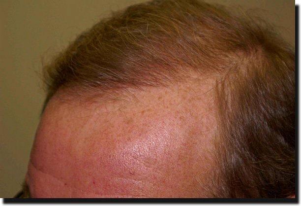 Hair restoration procedure results