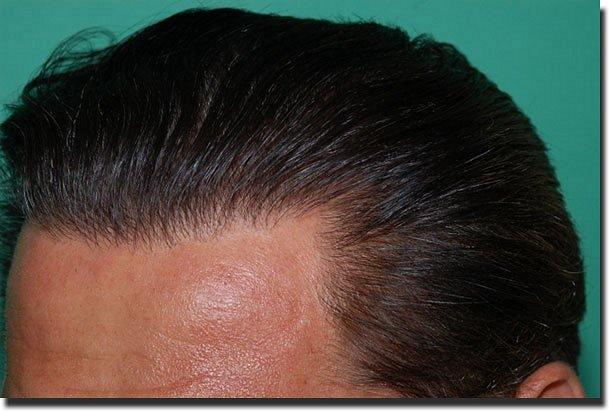 Hair restoration procedure results