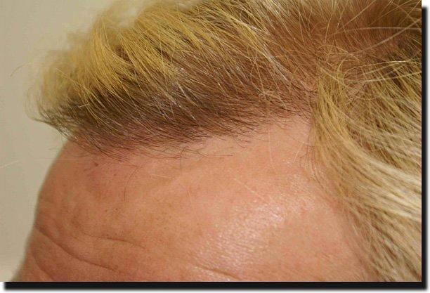 Hair restoration procedure results