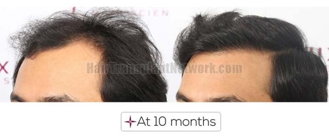 Left view before and after hair transplant surgery